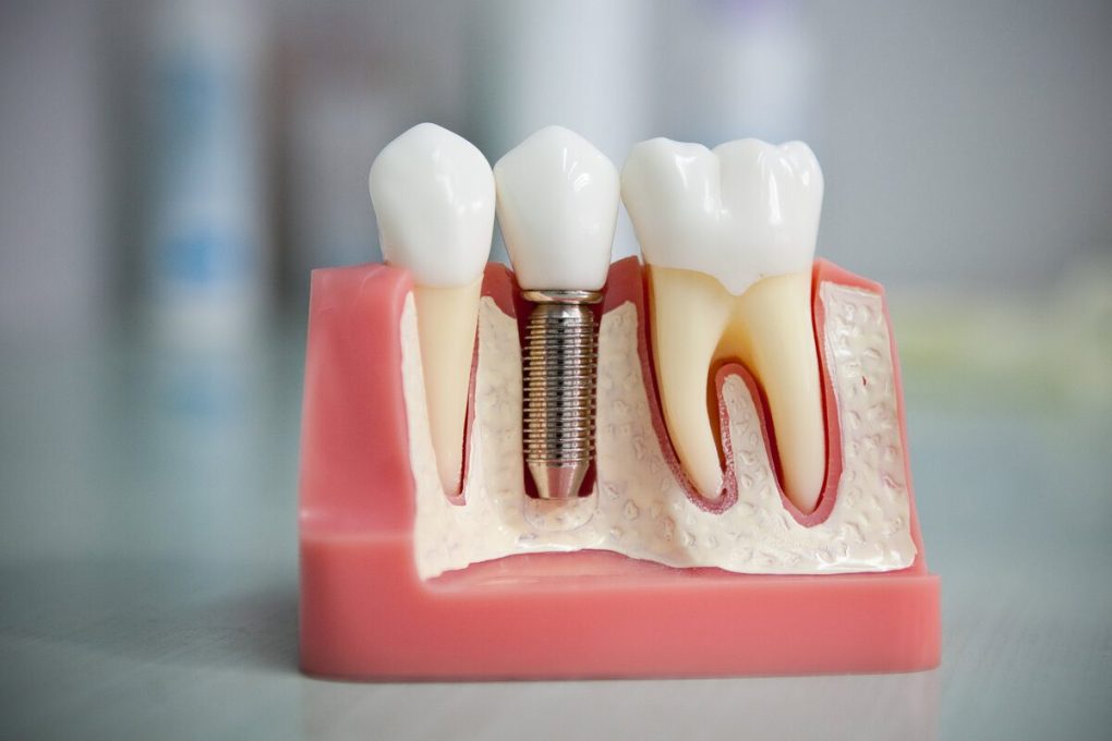 عوامل تحدد سعر زراعة الأسنان الفورية