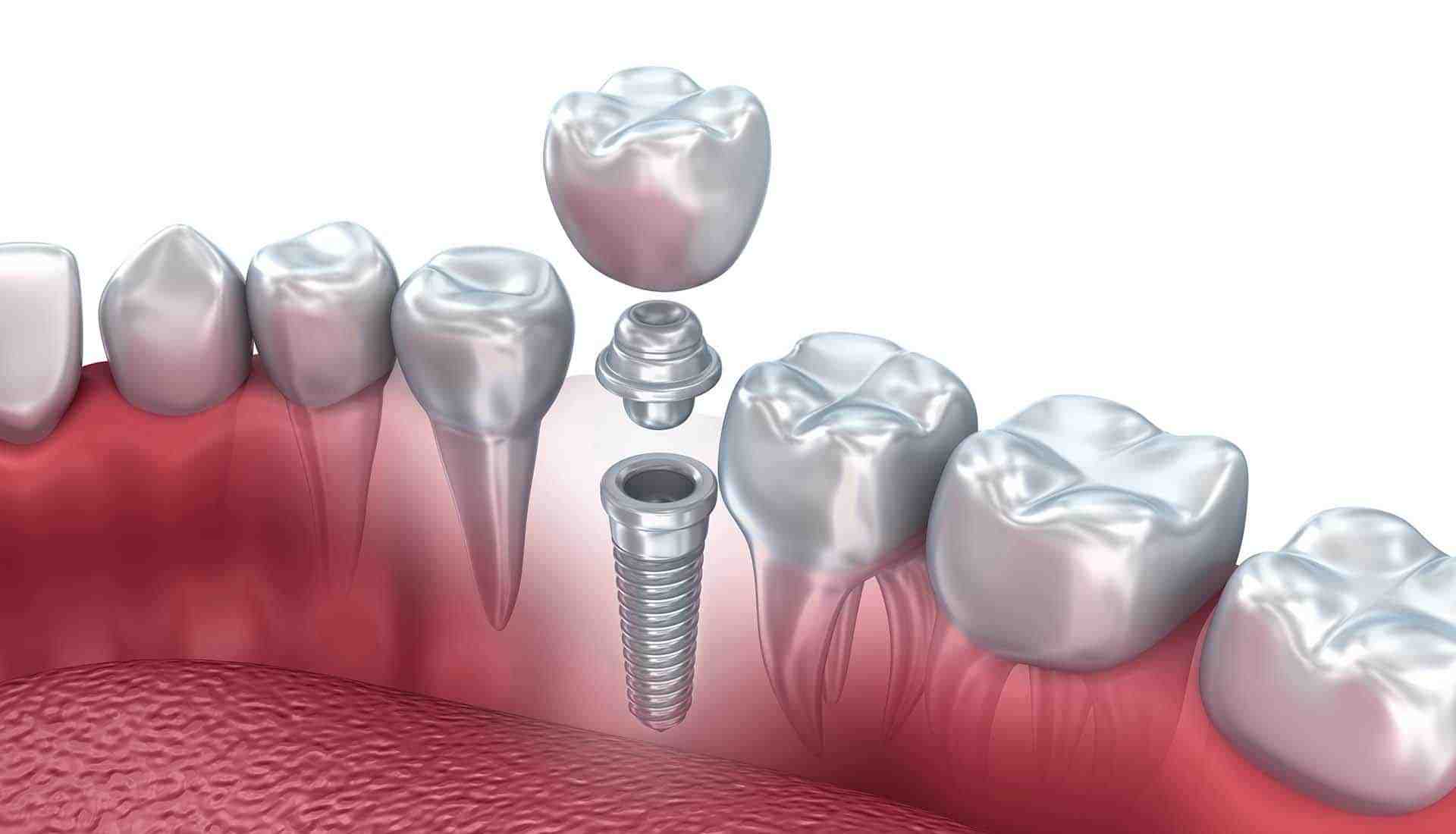 ماهي عملية زراعة الأسنان؟