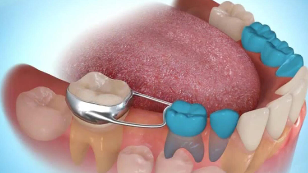ما هو البديل عن زراعة الأسنان؟