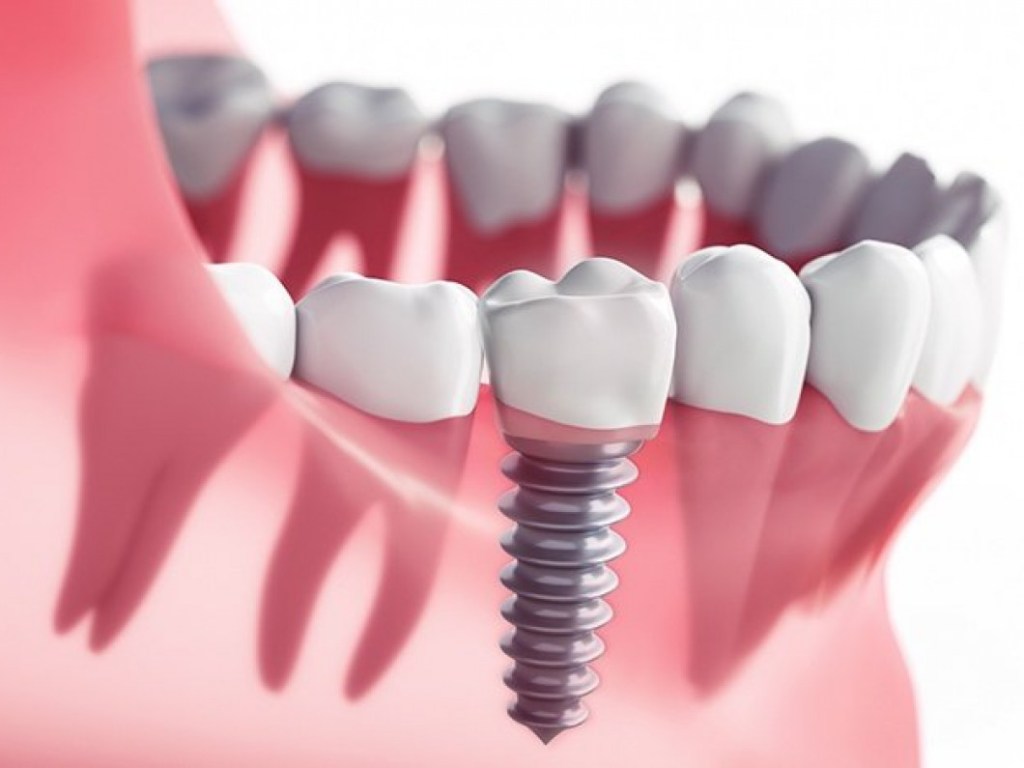 هل زراعة الأسنان الفورية أمنة؟ 