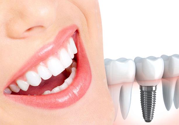 ما هي مميزات زراعة الأسنان ؟