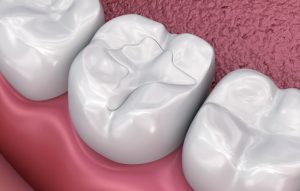 اكتشف معنا تجميل الاسنان بالحشوات التجميليه وما هي أبرز أنواعها؟
