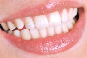الماسة التجميلية للأسنان وهل يمكن تزيين الأسنان بالكريستال؟