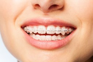 تعرف على تجميل الأسنان الأمامية بدون تقويم ومن هم الأشخاص المرشحون للقيام بها؟