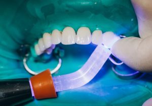 تعرف معنا على تجميل الأسنان بالفينير وأبرز البدائل التي من الممكن أن تحل محله
