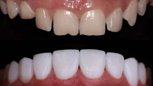 تفاصيل عن تجميل الاسنان بدون برد وما هي الفوائد التي من الممكن أن نحصل عليها منها؟