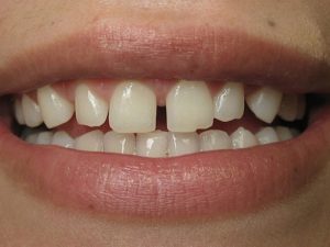 تعرف على تجميل فراغات الأسنان وما هو سبب تفرق الأسنان فجأة؟
