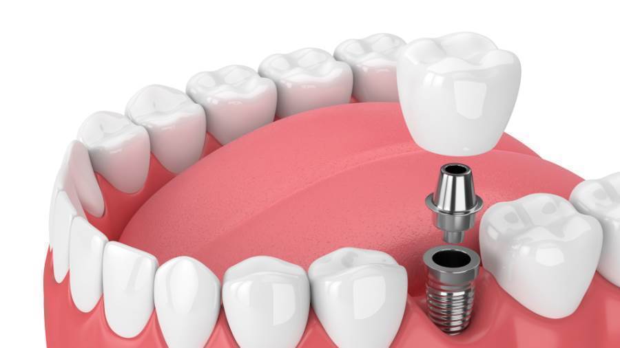 تعرف معنا على زراعة اسنان بالتقسيط والتجارب المختلفة معها!