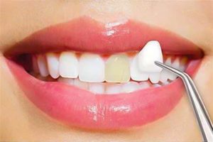ما هو فينير الاسنان