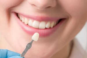 تفاصيل عن تجميل الأسنان الأمامية بالفينير ولماذا يستخدم فينير الأسنان لعلاجها؟