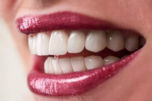 تجميل الاسنان الامامية البارزة وما هي الطريقة المميزة للإعادة الأسنان إلى مكانها الطبيعي؟