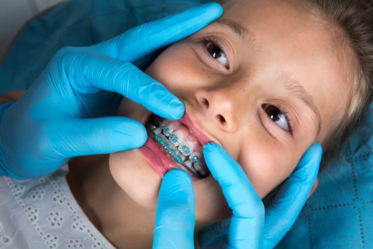 العمر المناسب لتركيب تقويم اسنان الاطفال