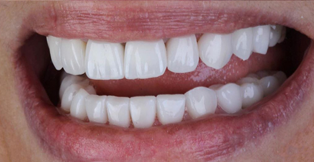 زراعة الأسنان الأمامية