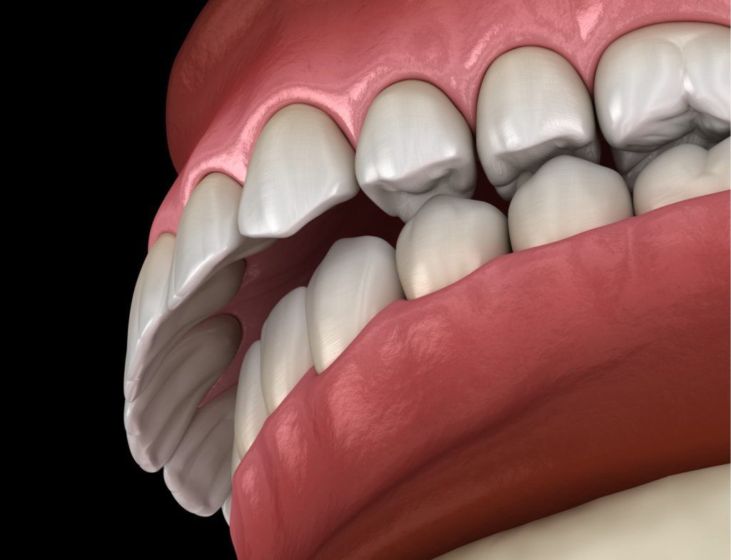 ما هو خطر عضة الأسنان الغير مضبوطة