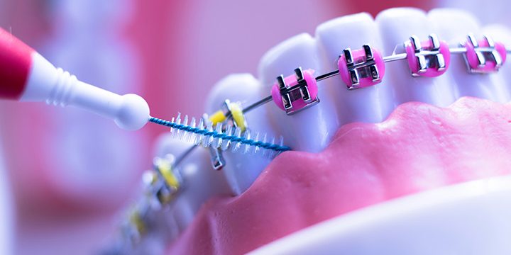 ما هي انواع تقويم الأسنان ؟