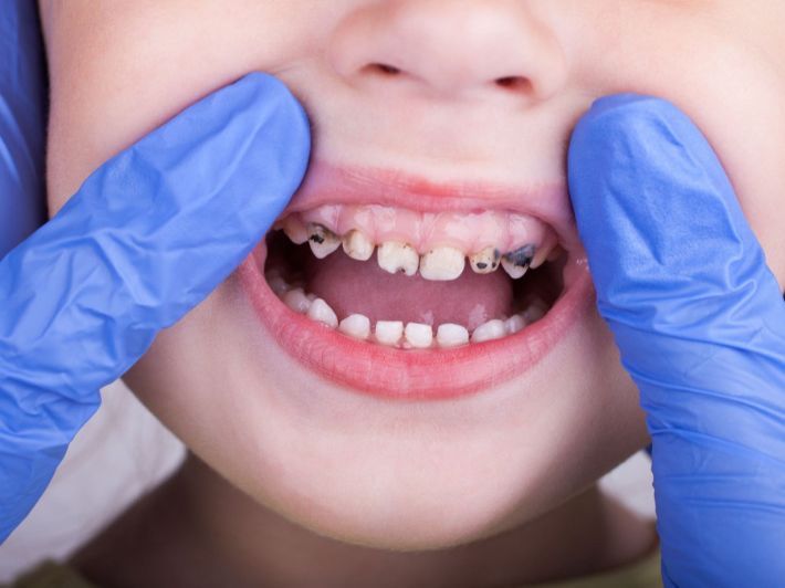 مشكلات الأسنان عند الأطفال