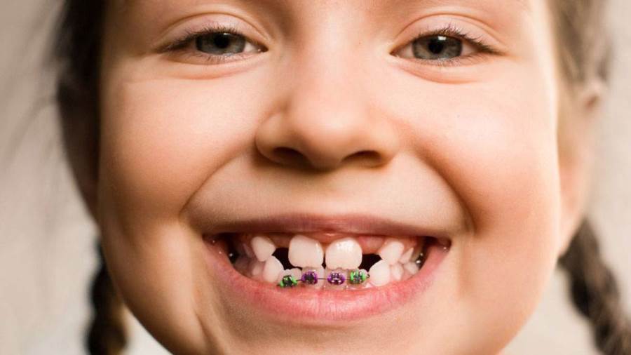 هل تقويم الأسنان مؤلم للاطفال
