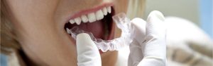 أسعار فينير الأسنان المتحرك: اكتشف أهم التجارب والمميزات والعيوب!