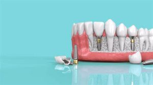 أفضل شركات زراعة الأسنان: اكتشف الفرق بين زراعة الأسنان الكوري والألماني!