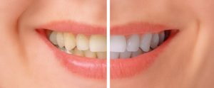 الفرق بين عدسات الأسنان