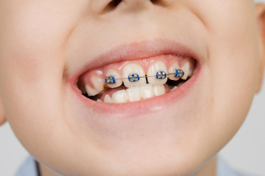 تعرف على أفضل دكتور تقويم اسنان اطفال وأحدث أنواع التقويم المستخدمة!