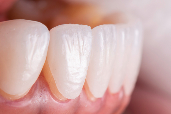 أنواع قشرة الأسنان