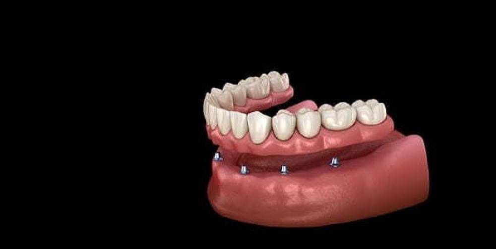 Cijene zubnih implantata u Egiptu