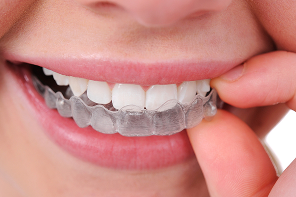  تقويم الاسنان الشفاف