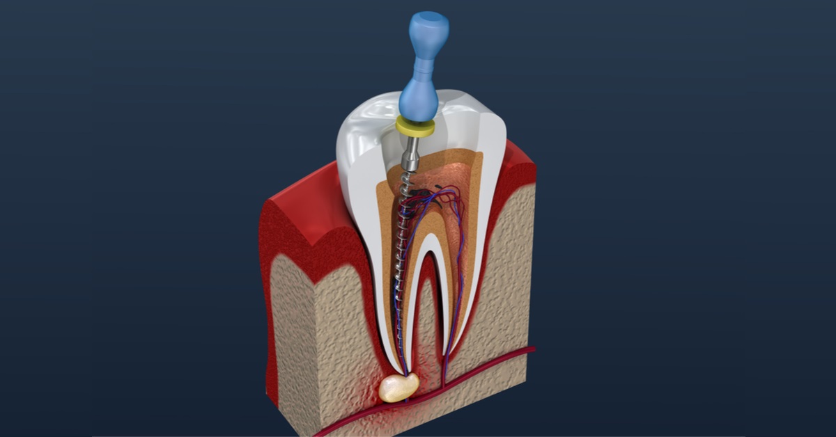 Dantų nervo plombavimas