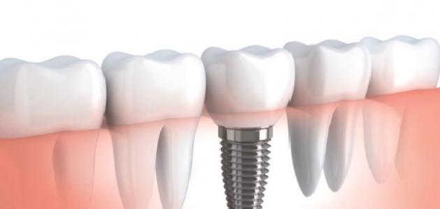 El preu de la instal·lació d'implants dentals a Egipte