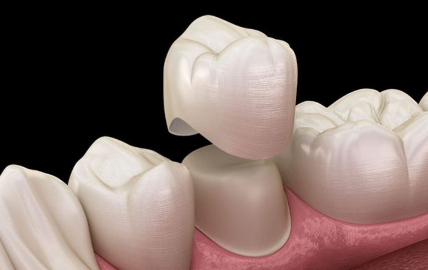 Tooth capping is uncomfortable