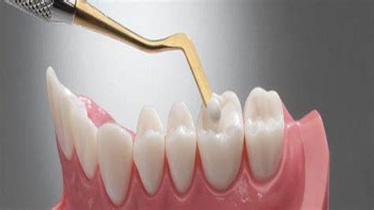 كيفية إجراء عملية حشو ليزر بلون الأسنان