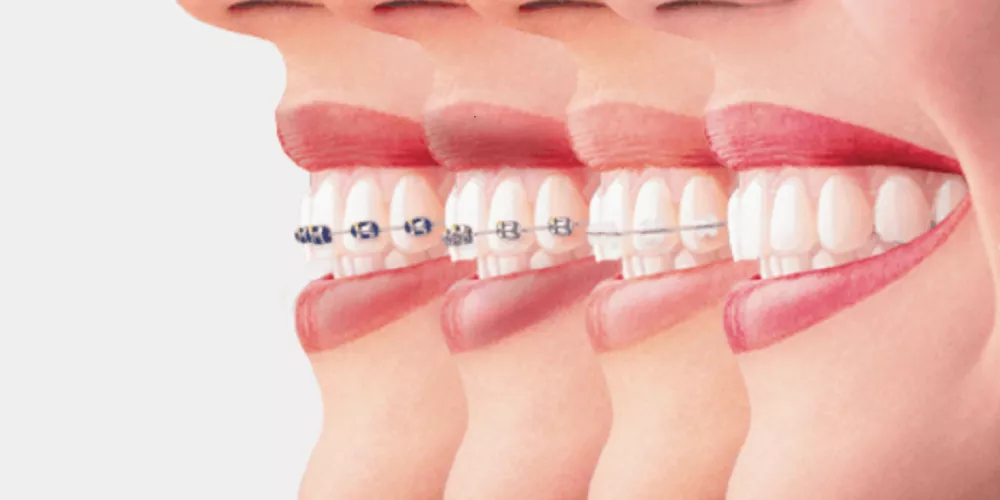 ما هي انواع تقويم الأسنان ؟
