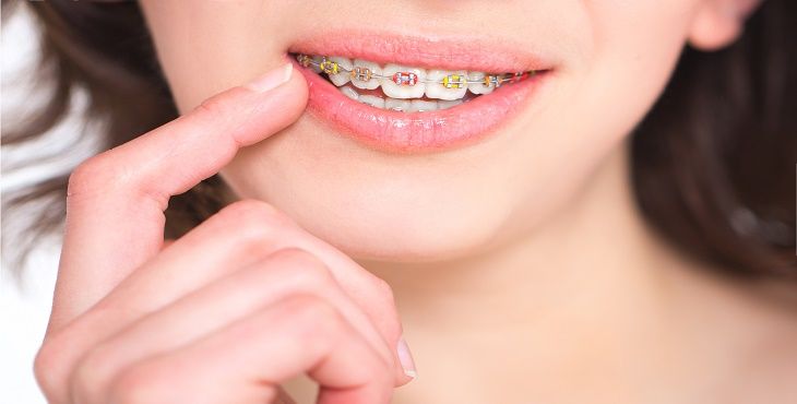 ما هي خطوات تركيب تقويم الاسنان؟