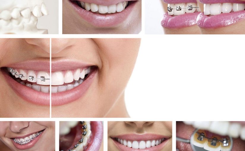 ما هي فوائد تقويم الأسنان ؟