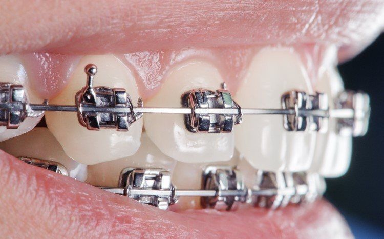 ما هي مكونات تقويم الأسنان