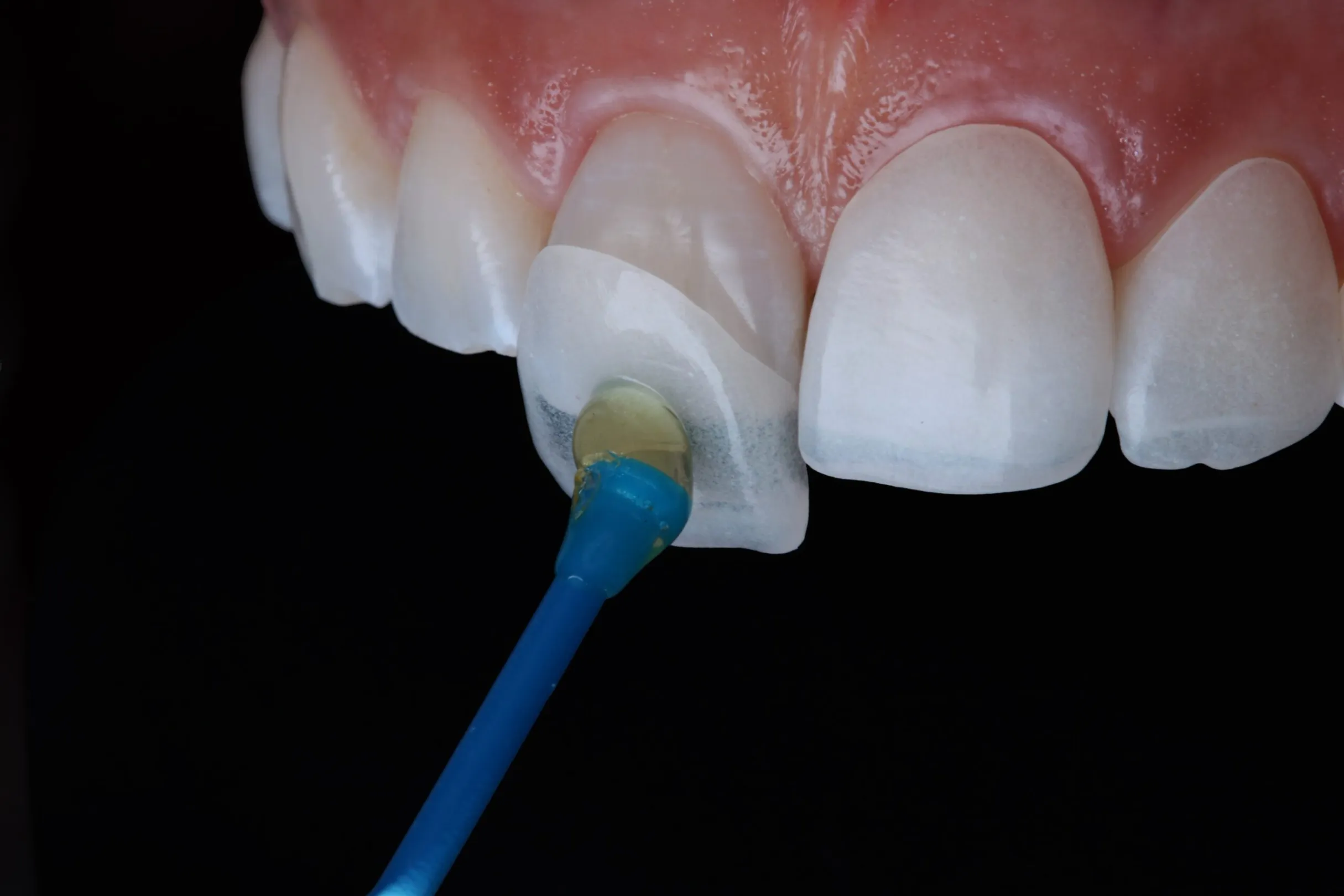 هل تركيب عدسات الأسنان الفينير مؤلم؟