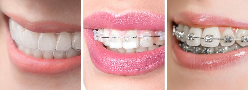هل تقويم الاسنان الشفاف فعال؟