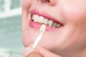 تجميل الأسنان الأمامية بالفينير وسعر فينير الأسنان