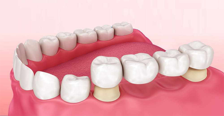 تركيب الأسنان الأمامية المتحركة وكم سعر تركيب طقم اسنان متحرك؟