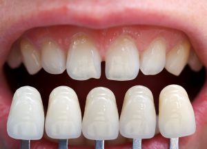 تركيب العدسات للاسنان وافضل مركز طبي لتركيب عدسات الاسنان في مصر