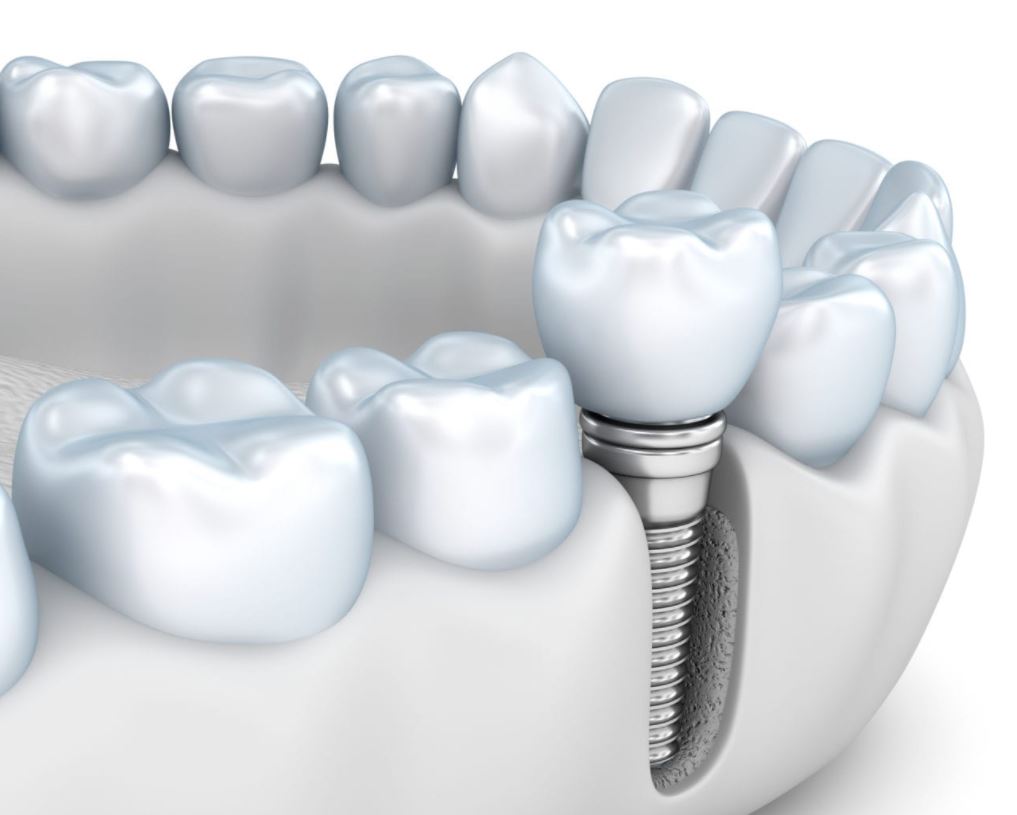 تعرف على كيفية تركيب ضرس ثابت وسعره في المركز الطبي لرعاية الأسنان!