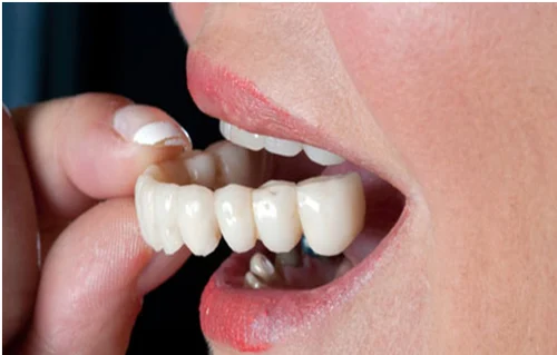 تركيبات الاسنان المتحركة وكم سعر تركيب اسنان متحركه؟