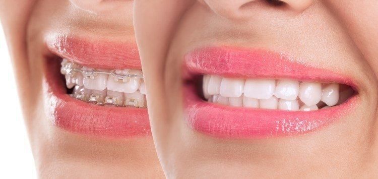 تعديل الأسنان بدون تقويم