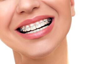 ما هو تقويم الأسنان الأمامية فقط؟ وتعرف على متوسط أسعاره في مركزنا الطبي لرعاية الأسنان