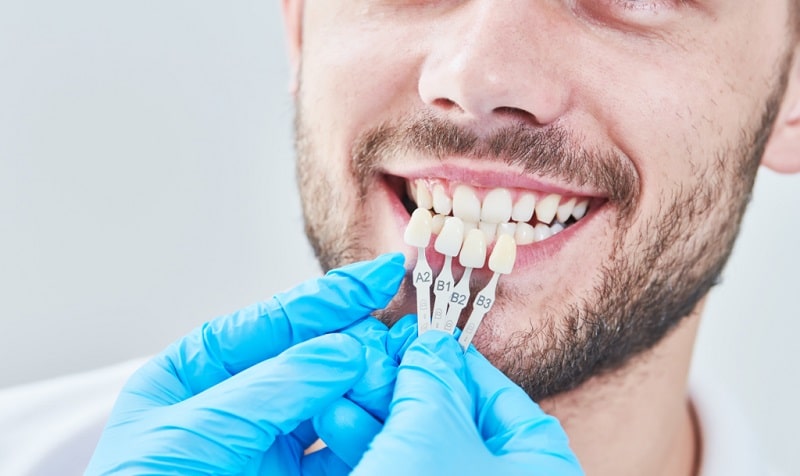 مميزات تعديل الأسنان دون تقويم