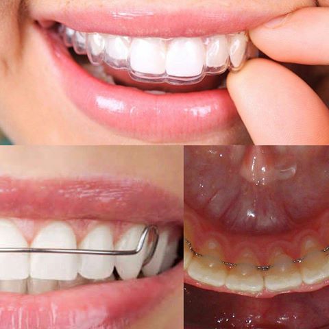 أنواع مثبت الأسنان بعد التقويم
