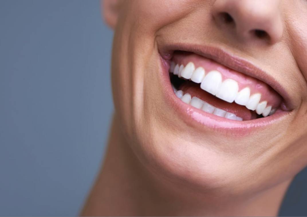 Hollywood bunny teeth smile