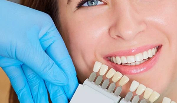 Best Hollywood smile color
