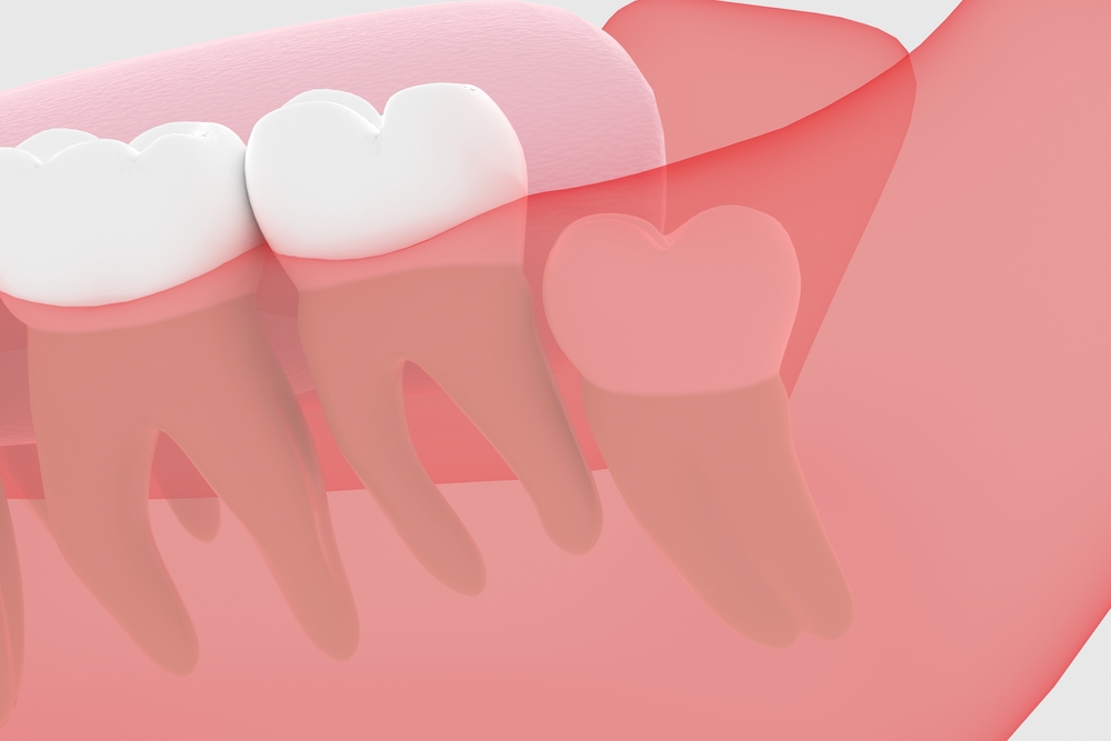 Impacted Teeth Surgery